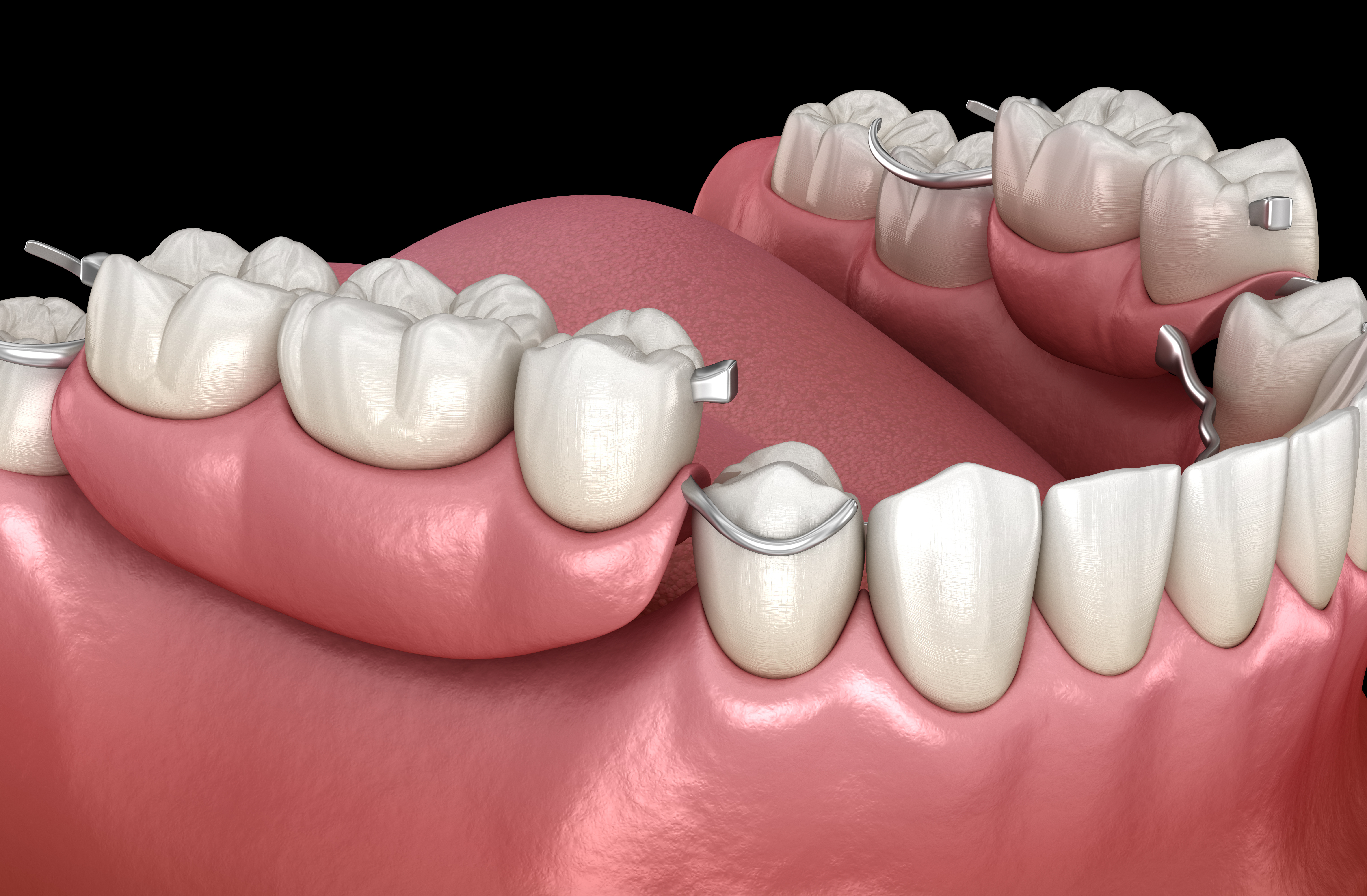 Виды протезирования зубов: какой вид выбрать 